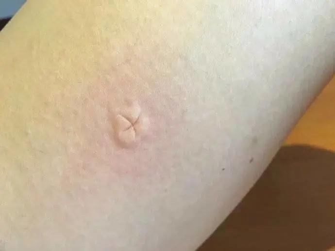 蚊虫叮咬性皮炎怎么快速止痒,一岁宝宝蚊虫叮咬如何快速止痒