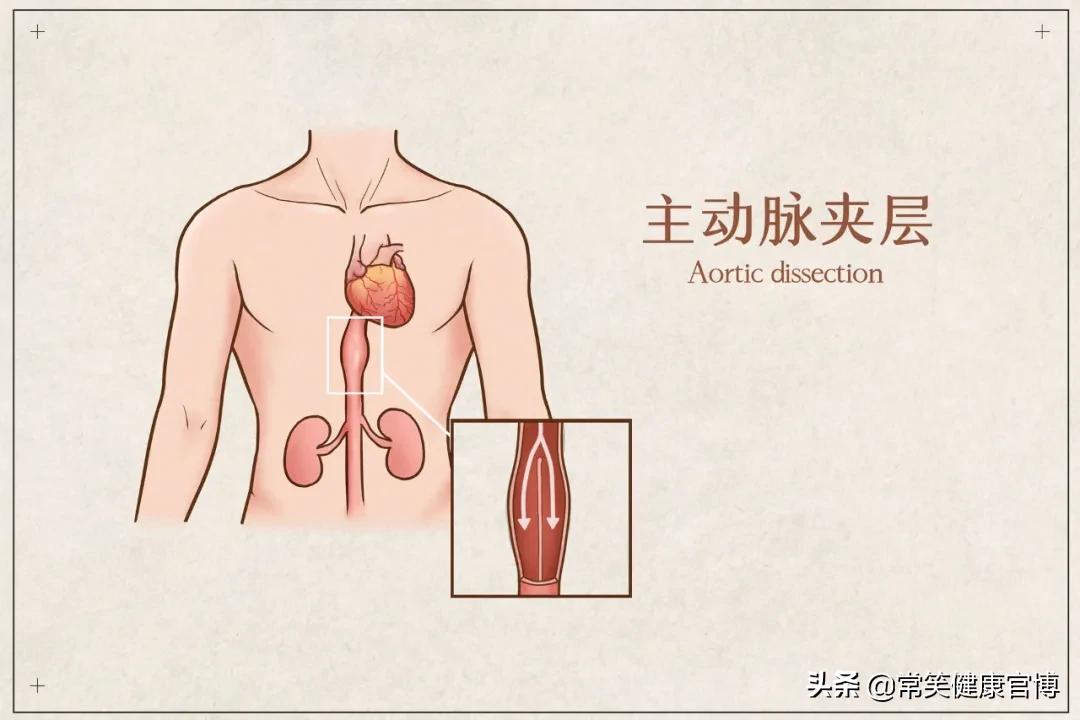 心脏主动脉夹层中医怎么治疗,得了主动脉夹层这个病怎么治疗