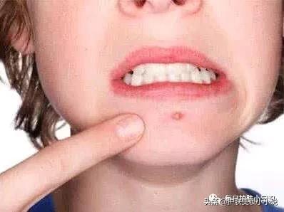 毛孔粗大有痘印如何改善女生,痘印毛孔粗大油皮如何消除