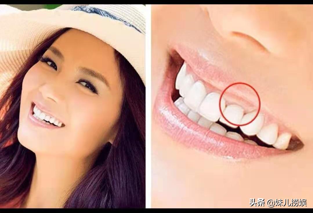 烤瓷牙美白注意事项,烤瓷牙选错颜色有点黄如何美白