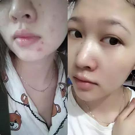 熬夜追《知否》后脸上狂暴痘？这些德国产品可以拯救你的脸！