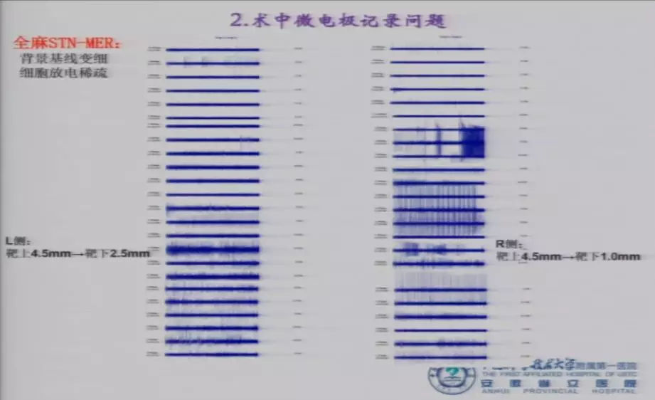 帕金森病dbs治疗和术后护理,帕金森病dbs理想靶点