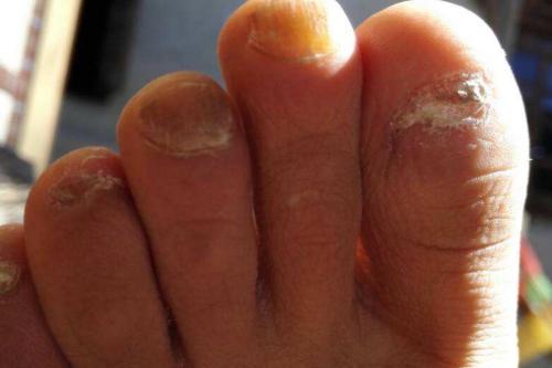 指甲增厚变色一定是灰指甲吗图片,指甲变空了发黄是灰指甲的图