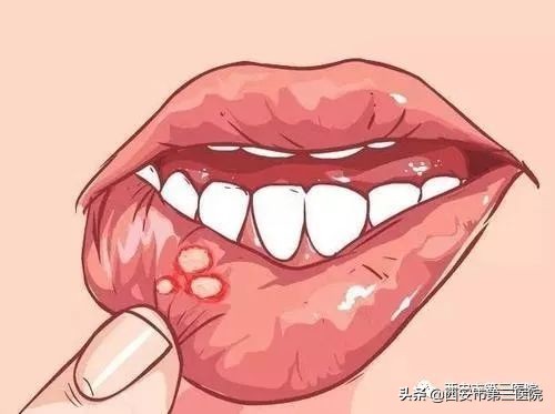 吃火锅治口腔溃疡,吃火锅口腔溃疡是什么原因