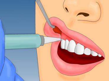 拔牙后血窟窿怎么清洁,拔牙后的血窟窿