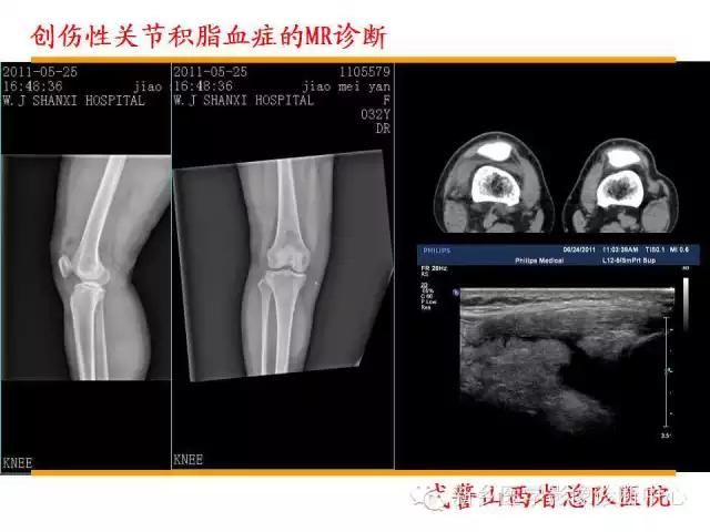 膝关节炎髌上囊积液自己看得出吗,髌上囊有积液膝盖会走路无力吗