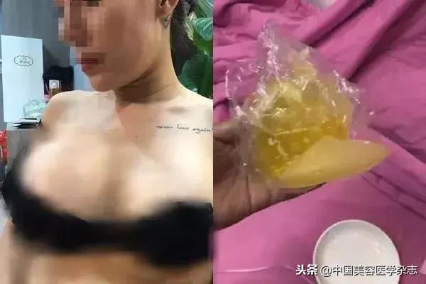 女歌手花1.4万元隆的胸在飞机上“爆了”！