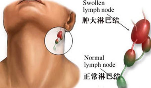 淋巴排毒属于虚假宣传吗,淋巴排毒自我按摩辟谣
