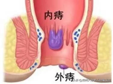 有痔之士的中医护肛妙方,有没有痔疮经过保守治疗不痛苦的