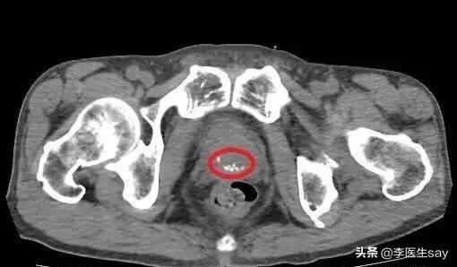 前列腺钙化是什么意思是好是坏,中医专家解疑前列腺钙化什么意思