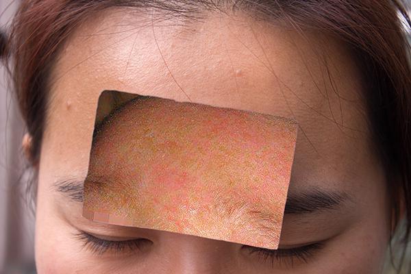 疮要怎么治疗,疮怎么治才能彻底根除