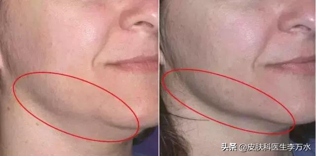 张雨绮说超声刀就像在烤肉?!线雕和超声刀,究竟哪个更靠谱?