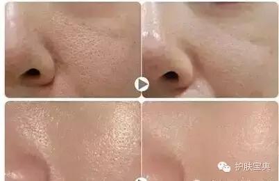 t区毛孔粗大怎么解决,鹤叔解决毛孔粗大