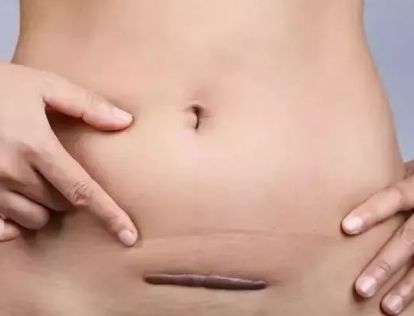 剖腹产竖切好还是横切恢复的好,剖腹产横切竖切可以自己选择吗