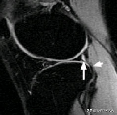 膝关节半月板损伤的磁共振,膝关节半月板病变的mri诊断与鉴别
