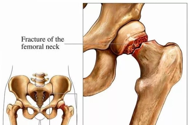 髋部骨折危害大老年人摔伤要重视,老人胯骨骨折死亡率