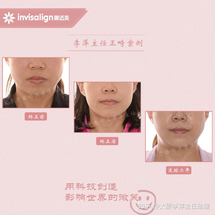 太原市牙齿正畸,太原市口腔正畸