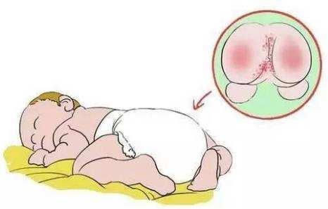 5个月宝宝得了肛瘘需要手术吗,3个月的宝宝肛瘘能自愈吗