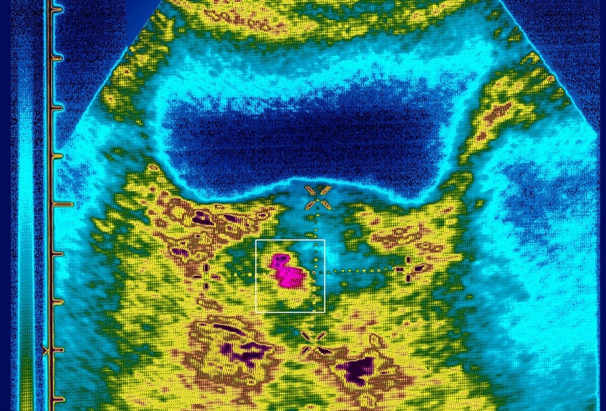 为什么会得前列腺钙化需要治疗吗,男性前列腺钙化是什么意思