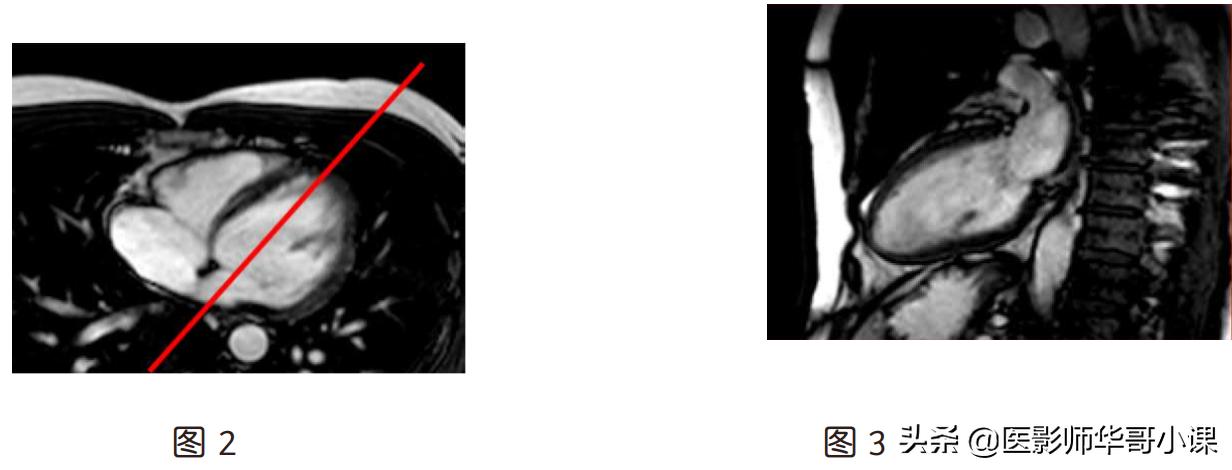 心脏mr增强扫描讲解,磁共振心脏扫描标准切面