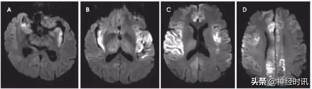 脑卒中的快速识别ppt,脑卒中神经影像学实例解析