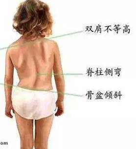 跷二郎腿骨盆倾斜可以正骨吗,跷二郎腿骨盆倾斜矫正