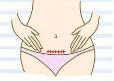 做过剖腹产的女性，还能有机会顺产么？