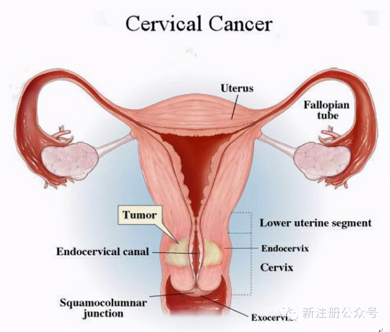 保护宫颈，远离癌症