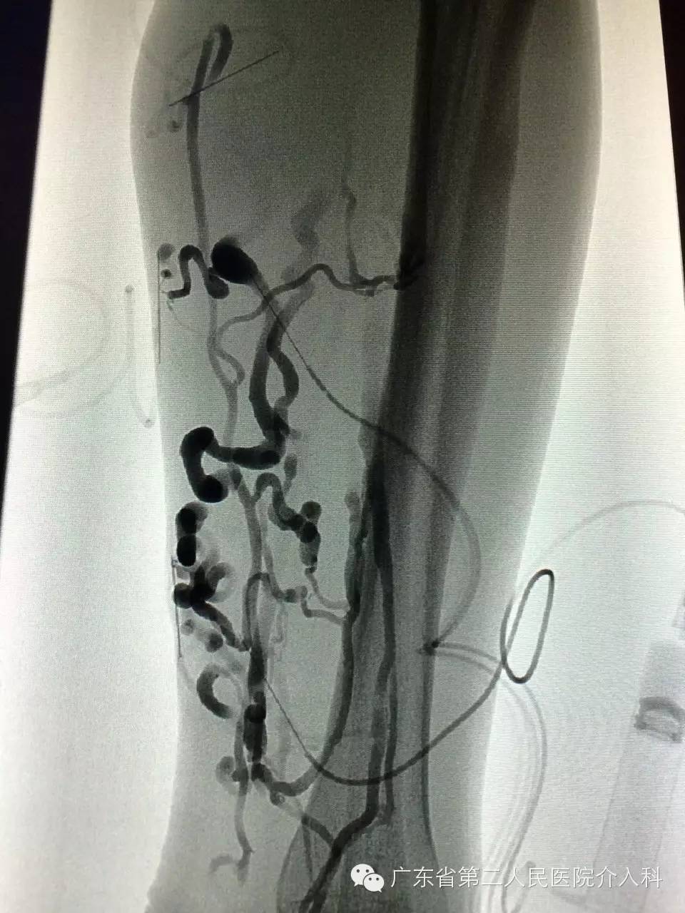 静脉曲张硬化治疗广泛应用…细针解决老难题，难看的蚯蚓腿不见了