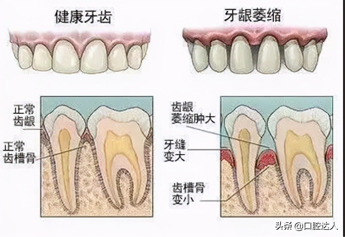 有牙缝做牙齿贴面好还是矫正好,牙缝太大先矫正再做贴面
