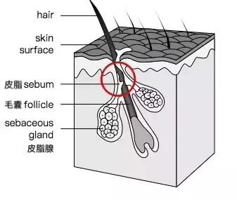 黑头为什么一直去不掉,黑头为什么总是去不掉