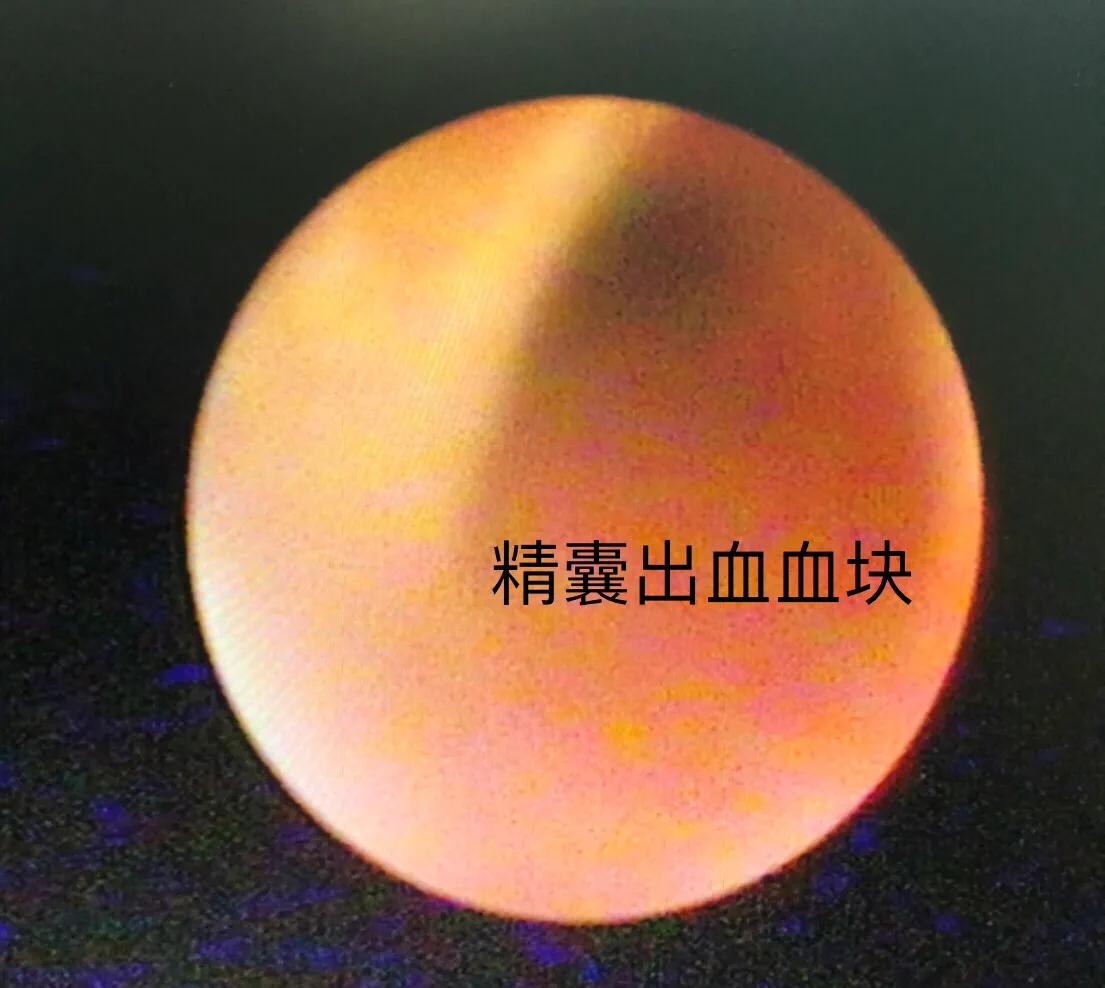 精囊结石精囊镜,精囊镜与钬激光手术