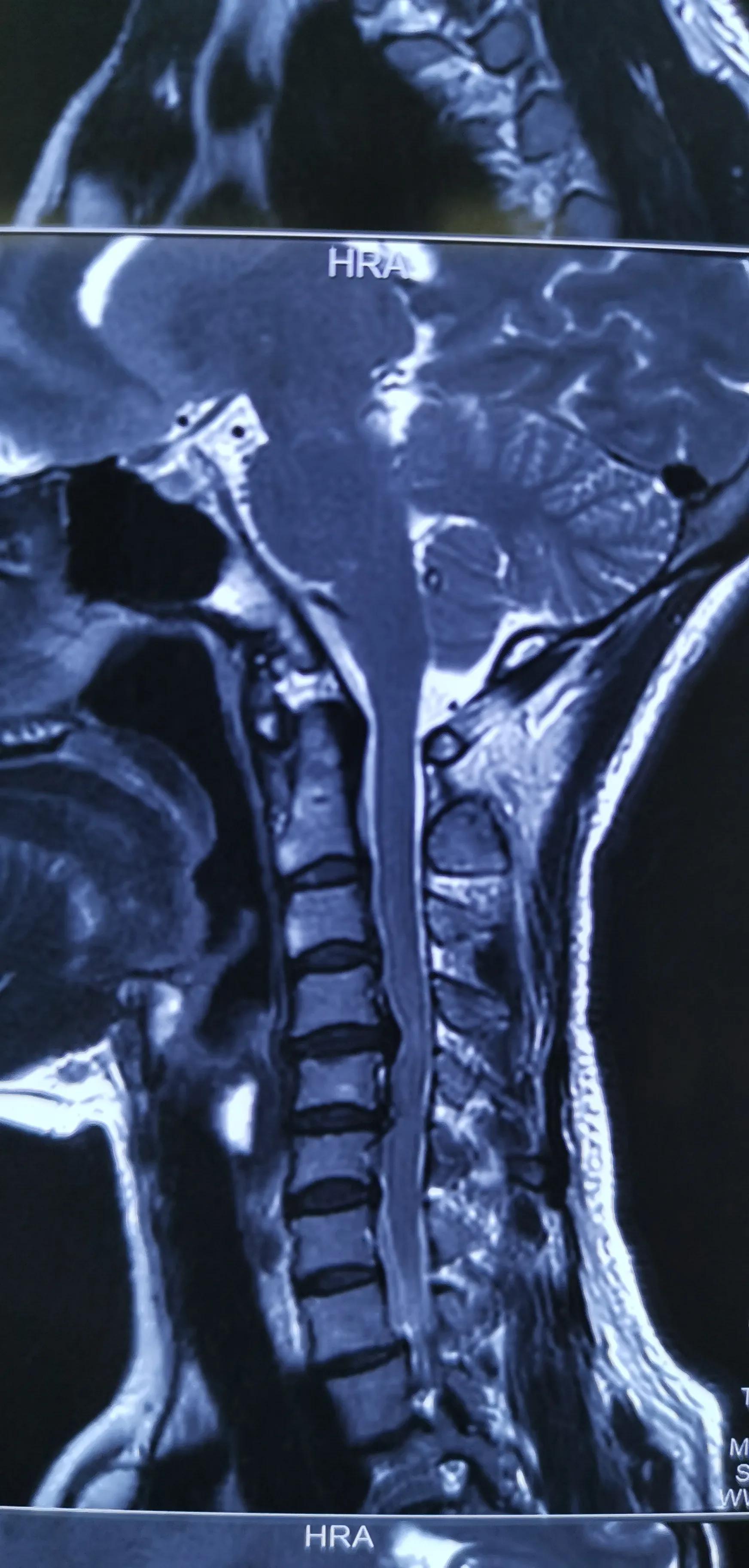 颈椎椎间盘轻度切除,颈椎全切除