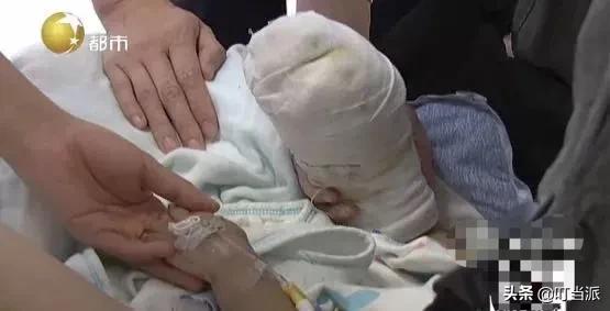 1岁娃被开水烫伤,几岁孩子大面积烫伤家长要注意