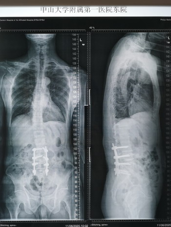 腰椎侧凸治疗方法,腰椎右侧凸最好的恢复方法