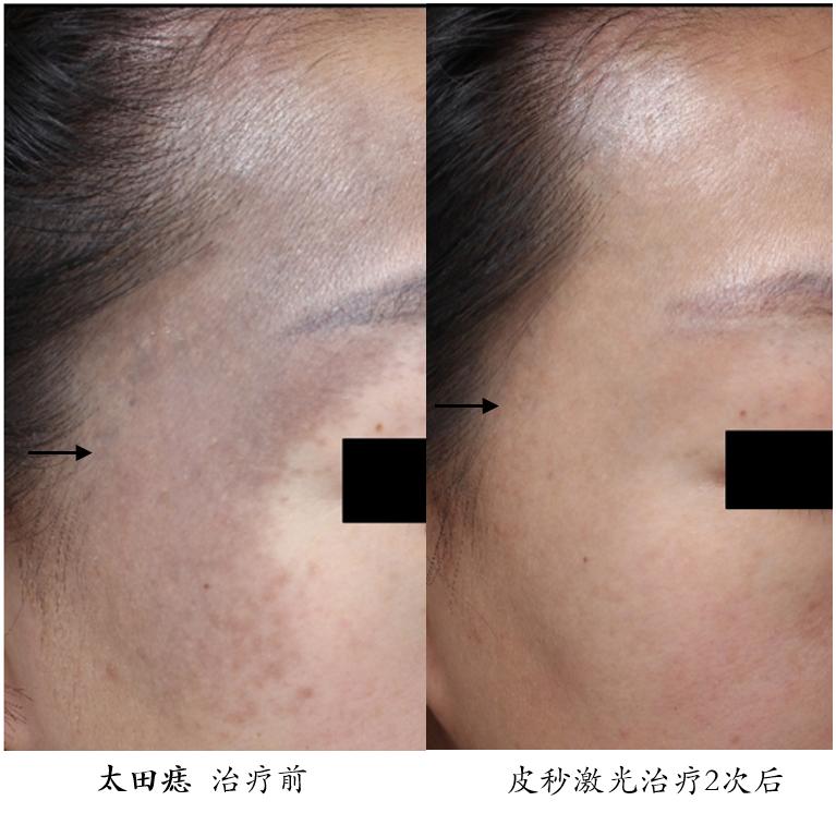 皮秒激光祛斑能保护表皮不受损伤,超皮秒激光祛斑的危害与效果视频