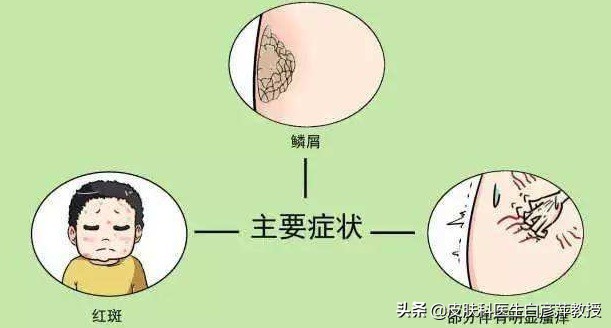 银屑病瘙痒的病理生理过程,敏感肌肤和系统性红斑狼疮