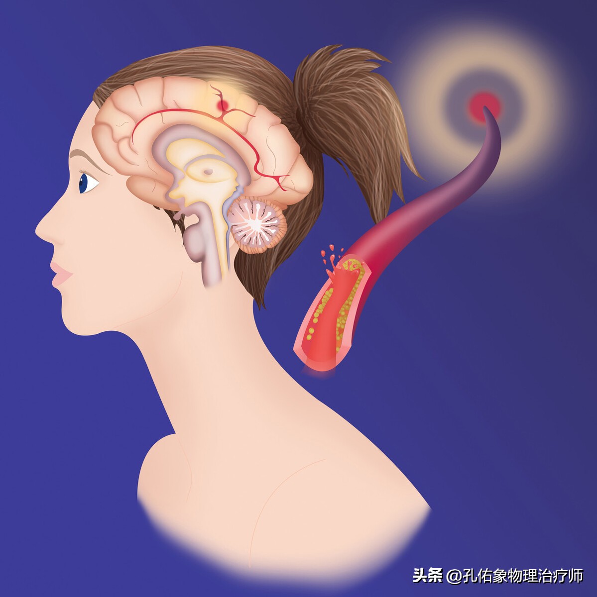 高血压脑出血急救最快的方法,血压高突发脑出血怎么治疗30岁