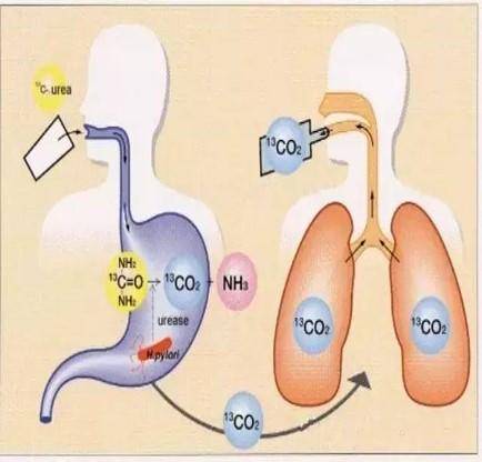 碳14呼气试验阴性表示没感染,碳14呼气试验阳性200是胃癌吗