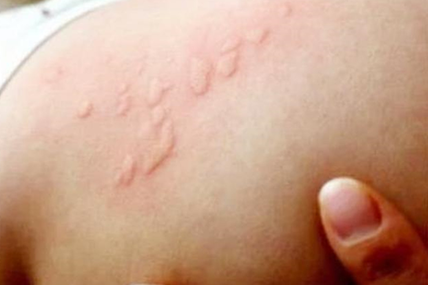 宝宝身上起了一块干燥起皮还有泡,宝宝身上起疙瘩破了还流水