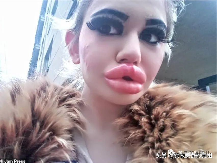 20次整容成功的女人,22岁女人做20次丰唇手术