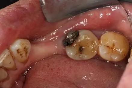 龋病最常见的修复方法,如何预防侧面龋