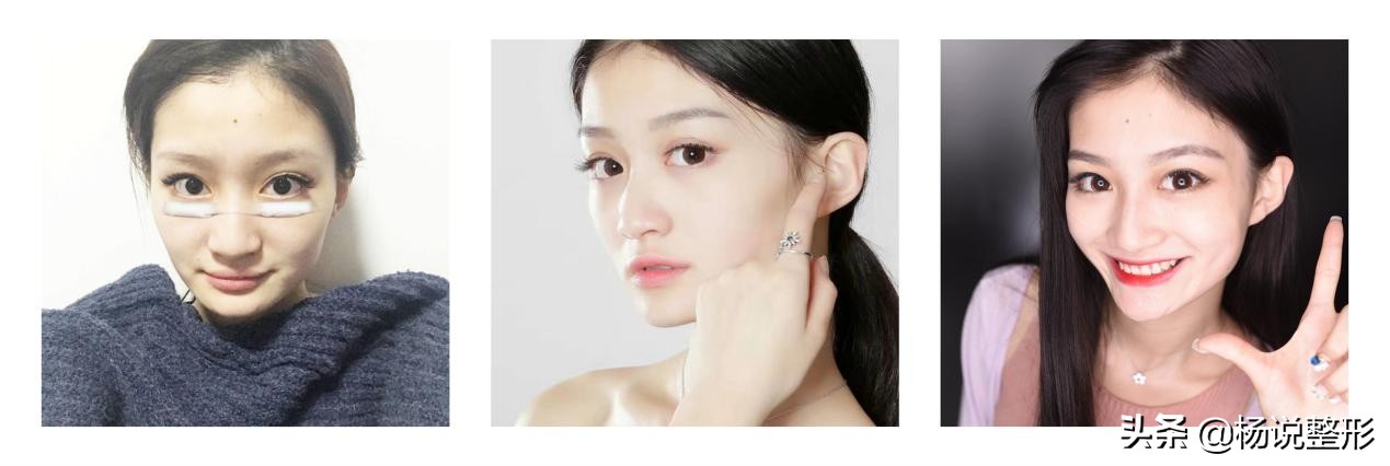 割完眼袋眼肿为什么,割完眼袋显得眼凶