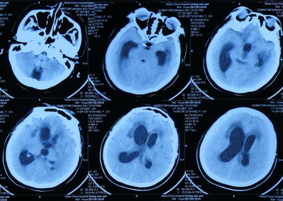 结核性脑积水,脑膜炎脑积水要治疗多久