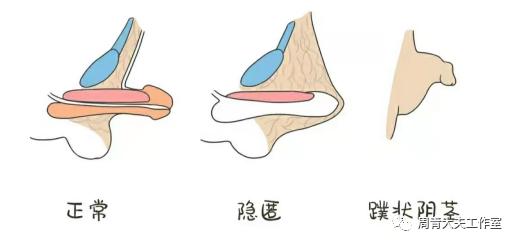 家长带孩子割包皮攻略,家长割包皮