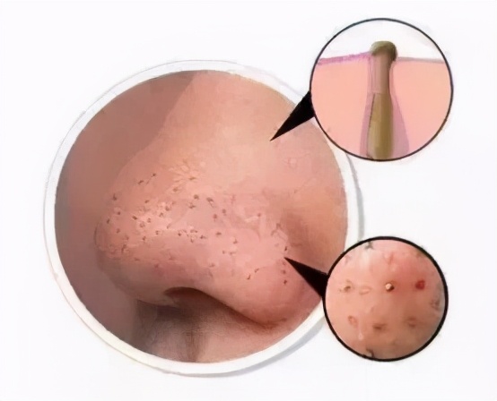 宋威龙、赵露思皮肤管理失败?毛孔粗大怎么办-四步改善毛孔粗大