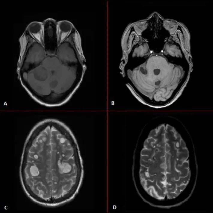 fda批准劳拉替尼一线治疗肺癌,alk第三代靶向药劳拉替尼
