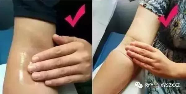 献血后部分人手臂针眼处为何会出现青紫？