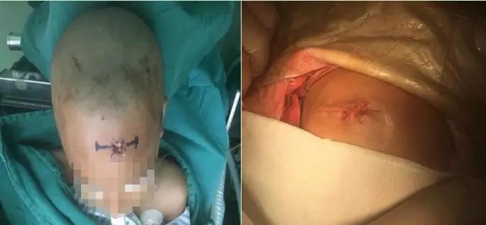 男孩摔到后脑勺做开颅手术,娃儿头骨摔断做开颅手术