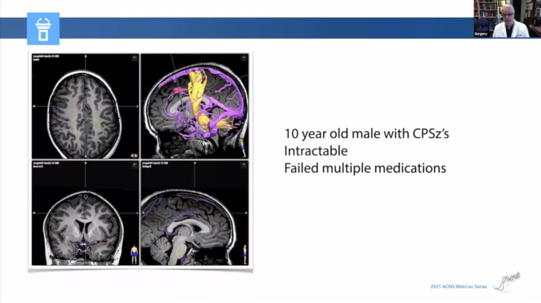 儿童癫痫治愈的真实案例,儿童难治性癫痫有哪些